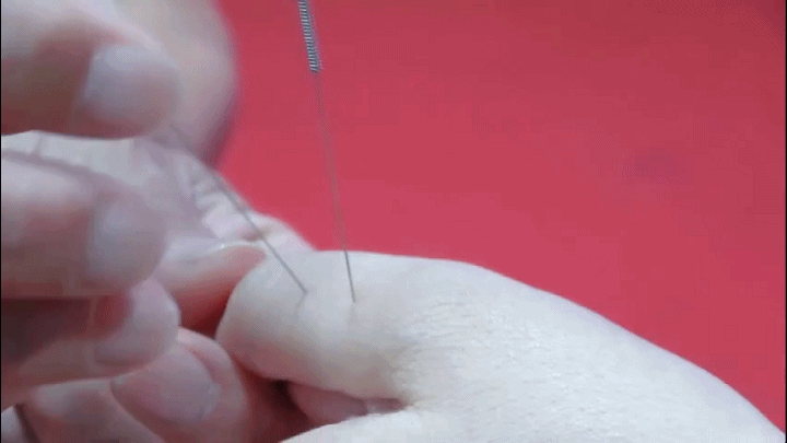 妇科还巢，操作细节，首次公开！